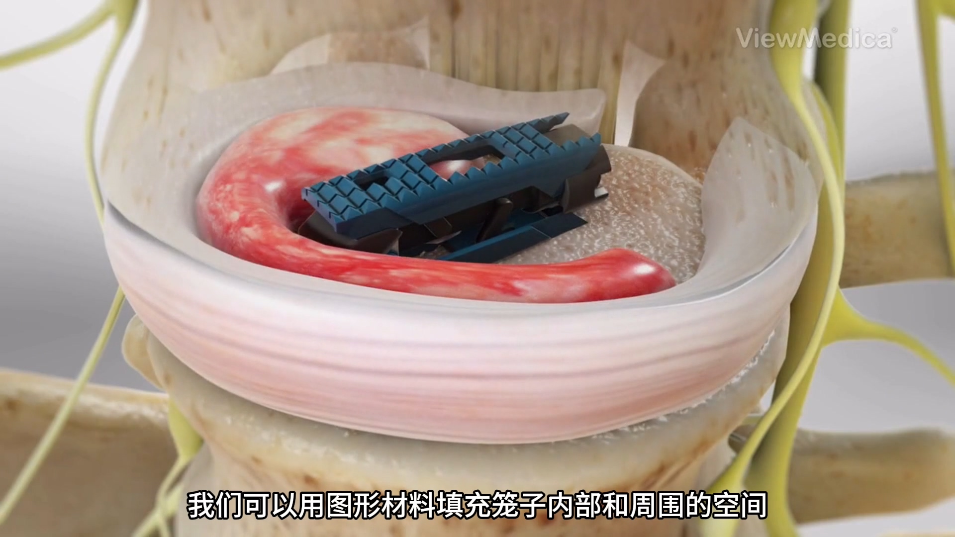 用可伸缩笼进行椎体间融合-医疗器械安装过程