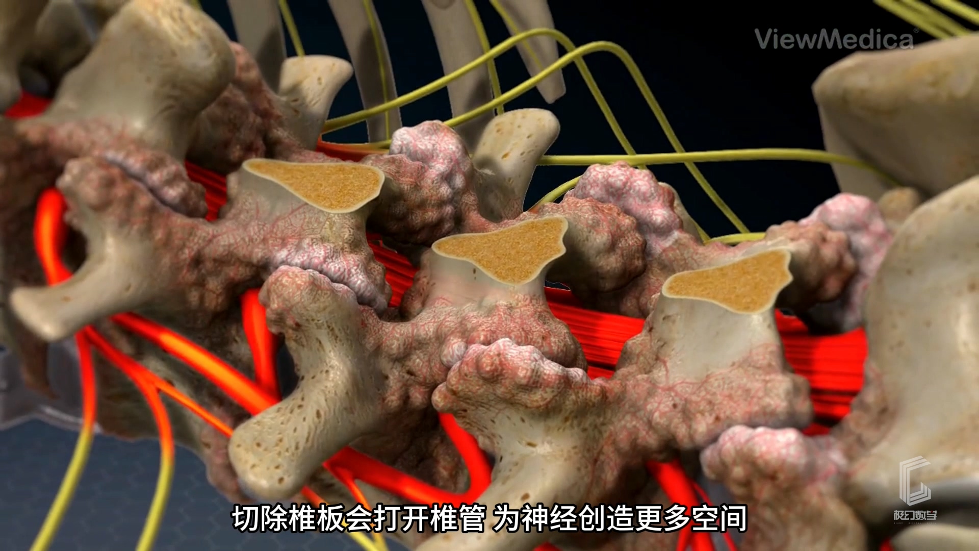 医疗椎板切除术\医疗动画制作公...