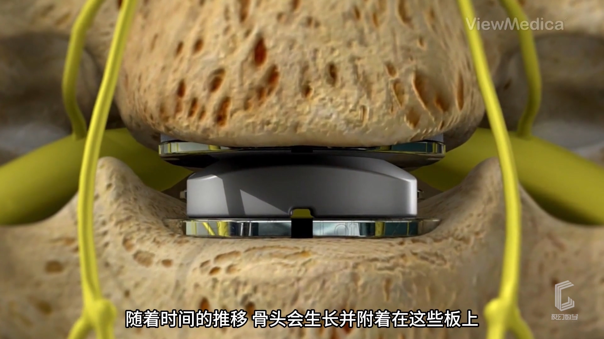 人工颈椎间盘置换术-医学3D动...
